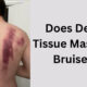 Does Deep Tissue Massage Bruise